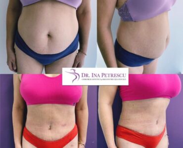 Abdominoplastie-gallery-001-860x912x0x0x860x912x1636448939