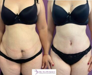 Abdominoplastie-gallery-002-430x342x0x0x430x342x1636448939