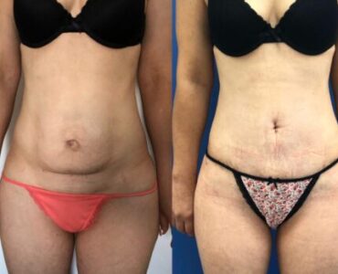 Abdominoplastie-gallery-003-452x452x11x0x430x452x1636448939