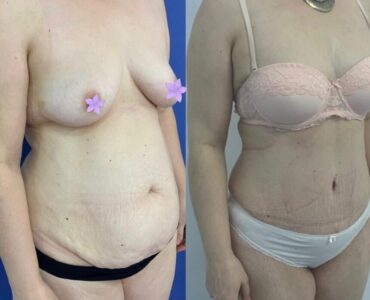 Abdominoplastie-gallery-004-878x878x8x0x860x878x1636448939