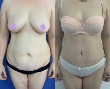 Abdominoplastie-gallery-005-860x860x0x0x860x860x1636448939