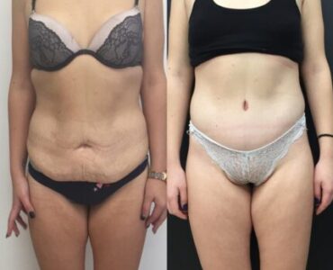 Abdominoplastie-gallery-006-439x439x4x0x430x439x1636448939