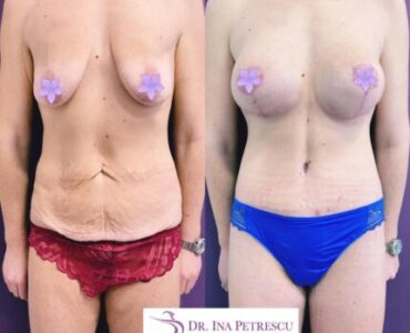 Abdominoplastie-gallery-007-434x384x2x0x430x384x1636448939