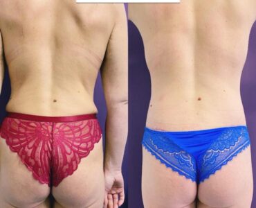 Abdominoplastie-gallery-008-928x866x34x0x860x866x1636448939