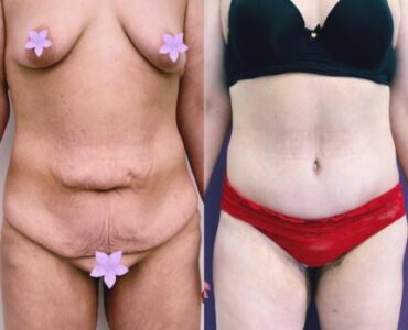 Abdominoplastie-gallery-009-430x430x0x0x430x430x1636448939