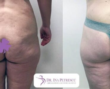 Abdominoplastie-gallery-010-990x422x64x0x860x422x1636448939