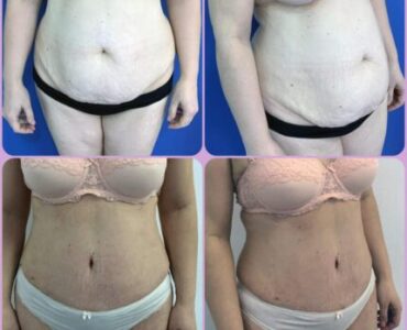 Abdominoplastie-gallery-011-430x430x0x30x430x387x1636448939