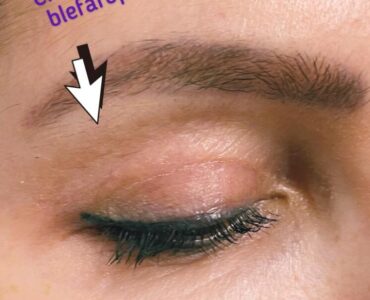 Blefaro-gallery-002-860x1152x0x6x860x1142x1636448939