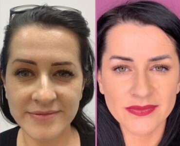 Botox-gallery-002-430x430x0x0x430x430x1636448939