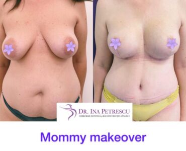 Mommy-makeover-gallery-2-860x730x0x88x860x642x1636448939