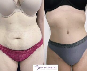 abdominoplastie-jan2023-1-430x321x0x0x430x321x1675262660