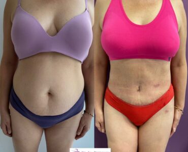 abdominoplastie-jan2023-2-860x756x0x4x860x748x1675262662