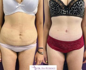 abdominoplastie-jan2023-3-430x344x0x12x430x320x1675262666