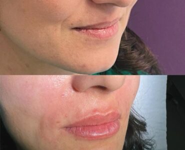 acid-hialuronic-jan-2023-7-878x878x8x0x860x878x1675262846
