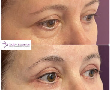 blefaro 1
