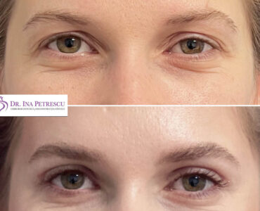 blefaroplastie-jan-2023-10-min-948x948x44x22x860x904x1675264685