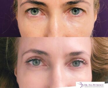 blefaroplastie-jan-2023-3-min-878x892x8x0x860x892x1675264670