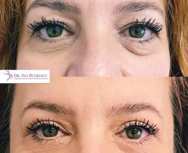 blefaroplastie-jan-2023-4-min-434x434x2x0x430x434x1675264672
