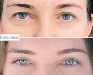 blefaroplastie-jan-2023-5-min-470x470x20x11x430x447x1675264674