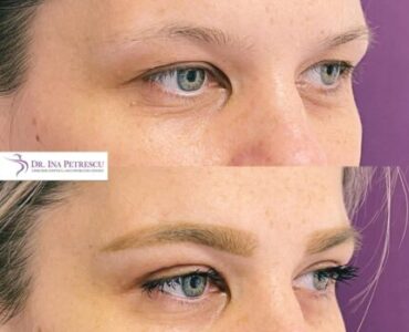 blefaroplastie-jan-2023-6-min-430x430x0x0x430x430x1675264677