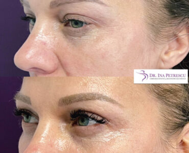 blefaroplastie-jan-2023-7-min-912x912x26x22x860x868x1675264679