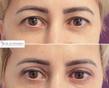 blefaroplastie-jan-2023-8-min-452x452x11x11x430x430x1675264681