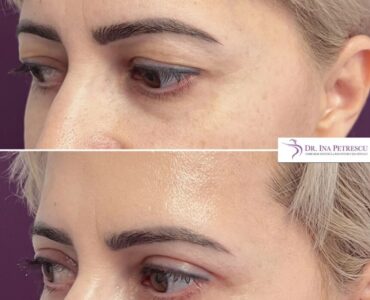 blefaroplastie-jan-2023-9-min-904x904x22x22x860x860x1675264683