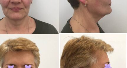 galerie-facelift-v3-05-1032x1032x116x0x860x1032x1636448939