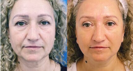 galerie-facelift-v3-07-430x430x0x30x430x292x1636448939