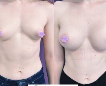 galerie-marire-sani-cu-implant-mamar-v3-04-525x430x47x0x430x430x1636448939