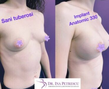 galerie-marire-sani-cu-implant-mamar-v3-05-477x358x24x0x430x358x1636448939