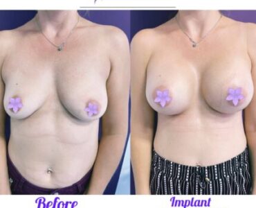 galerie-marire-sani-cu-implant-mamar-v3-08-430x430x0x2x430x426x1636448939