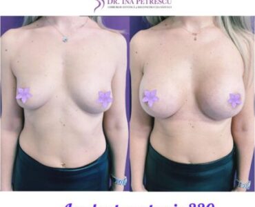 galerie-marire-sani-cu-implant-v5-001-430x430x0x2x430x426x1636448939