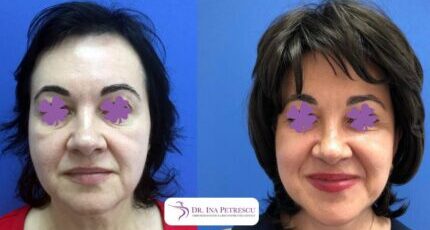 lifting-facial-gallery-001-477x238x24x0x430x238x1636448939