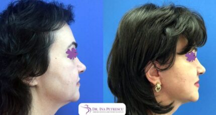 lifting-facial-gallery-002-928x498x34x0x860x498x1636448939