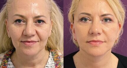 lifting-facial-jan-2023-2-430x430x0x9x430x413x1675265870