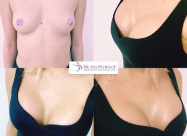 marire-implant-jan-2023-1-878x878x8x0x860x878x1675266660