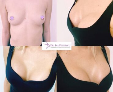 marire-implant-jan-2023-1-878x878x8x0x860x878x1675266660