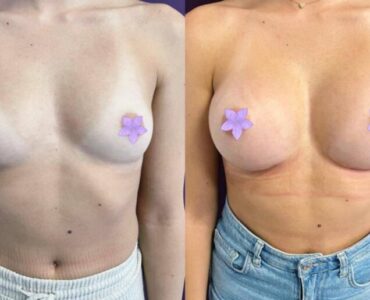 marire-implant-jan-2023-10-860x662x0x72x860x516x1675266674