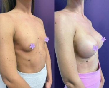 marire-implant-jan-2023-11-430x333x0x0x430x333x1675266675