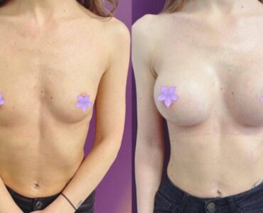 marire-implant-jan-2023-12-860x582x0x34x860x512x1675266676
