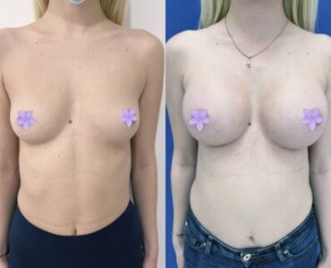 marire-implant-jan-2023-2-430x321x0x0x430x321x1675266662