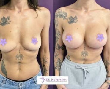 marire-implant-jan-2023-7-430x319x0x3x430x313x1675266669