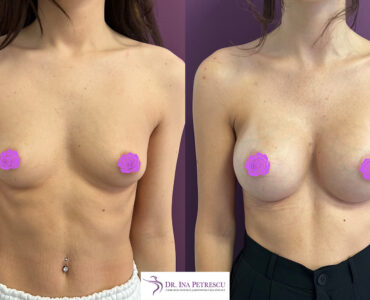 marire sani cu implant front