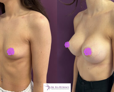 marire sani cu implant side 2