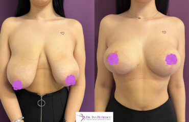 masto cu implant front