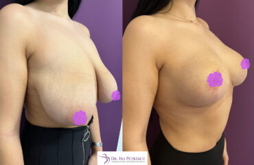 masto cu implant side 2