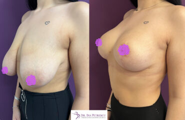 masto cu implant side