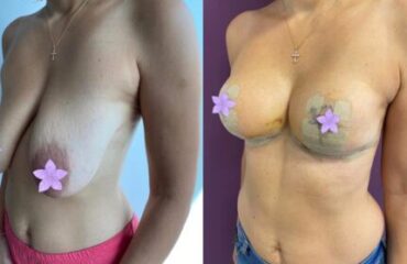 masto-fara-implant-gallery-003-507x339x39x0x430x339x1636448939
