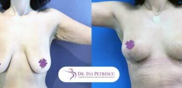 masto-fara-implant-gallery-004-456x180x13x0x430x180x1636448939
